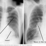 Síntomas y tratamientos de la tuberculosis: lo que debes saber